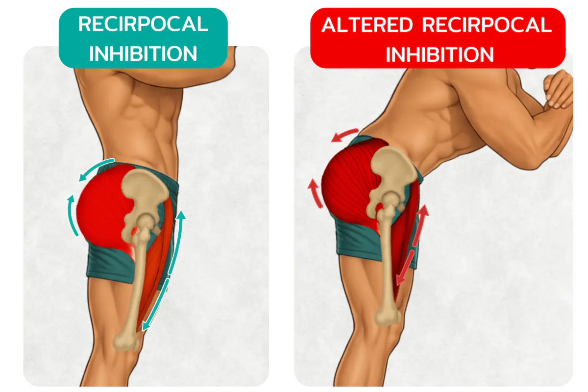 Illustration: Cause #1: Tight Hip Flexors