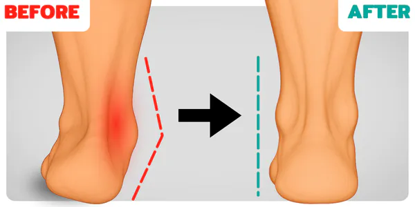 How to Correct Overpronation (Fallen Arches)