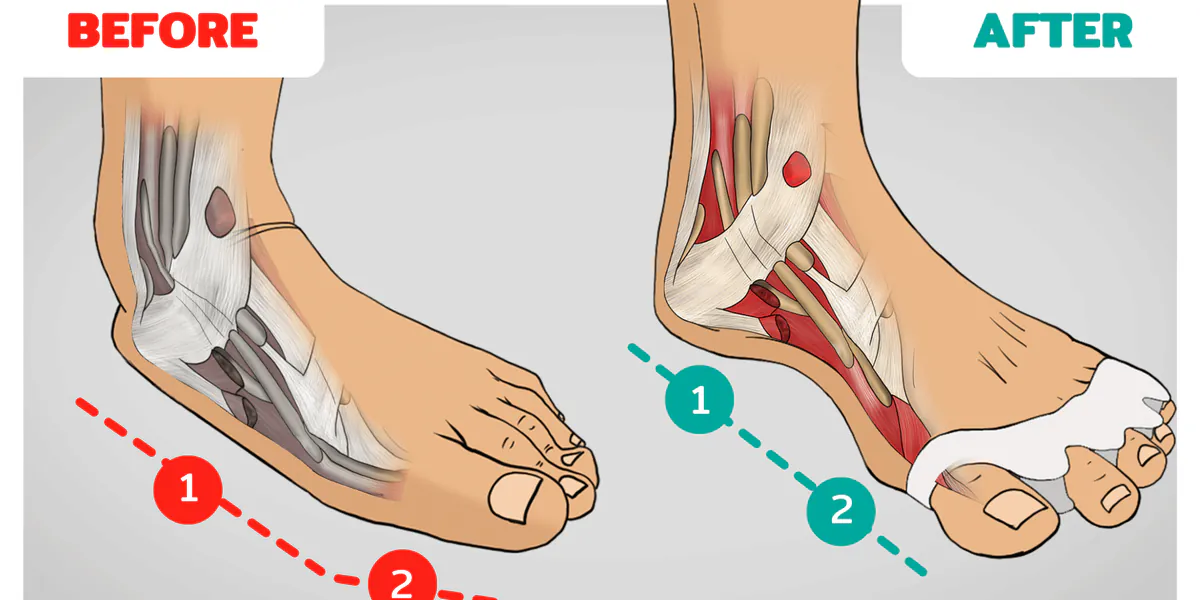 How to Fix Bunions & Flat Feet at the Same Time