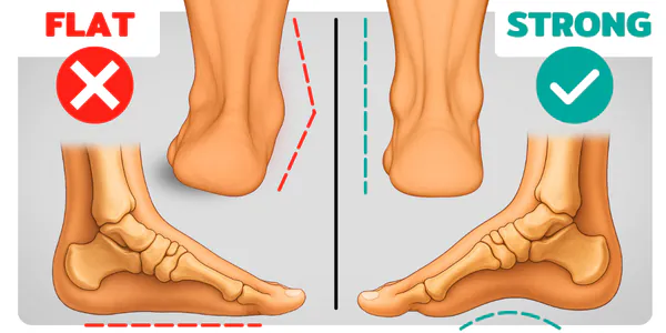 How to Fix Flat Feet (fallen arches) in 4 Steps