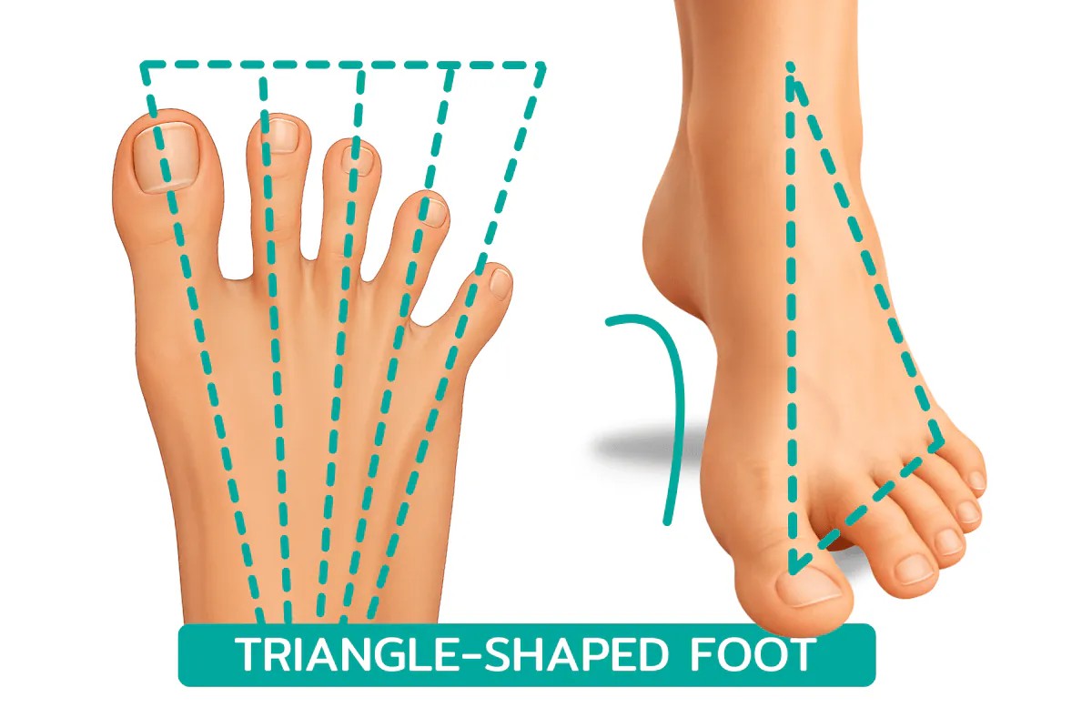 Illustration: Step 3: Restore Proper Toe Splay