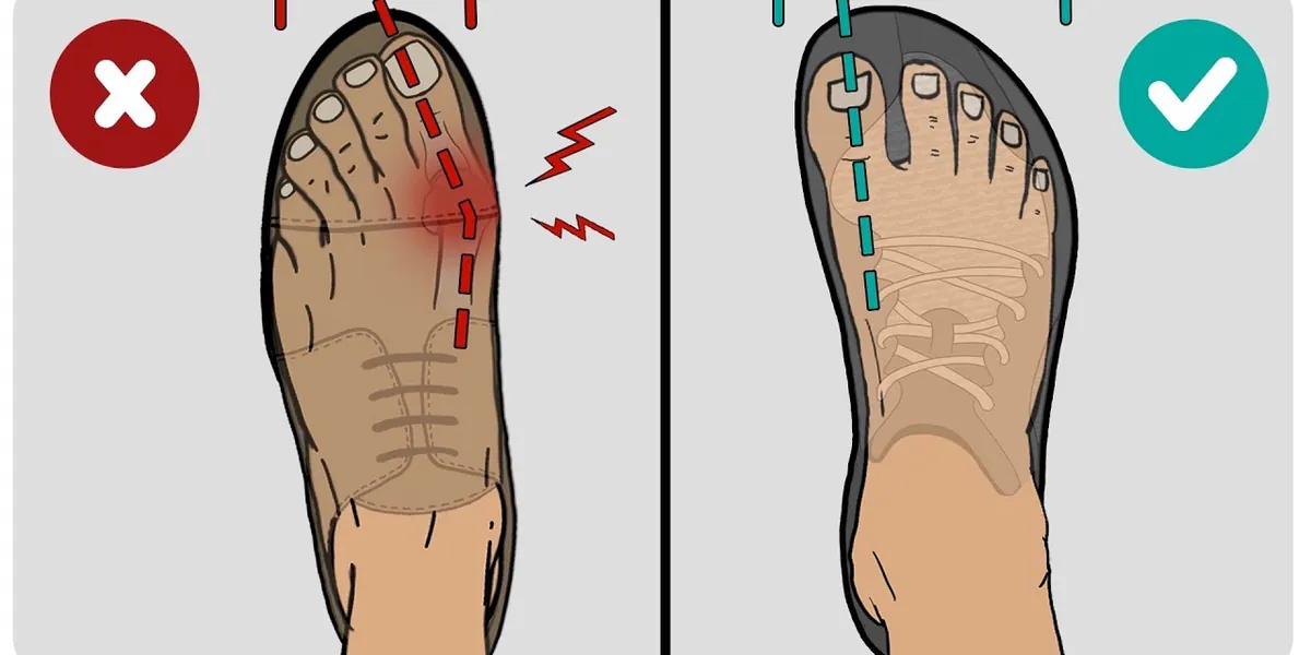 The Best Type of Shoes for Bunions