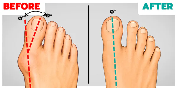 99% of People STILL Don’t Know the Basics of Fixing Bunions