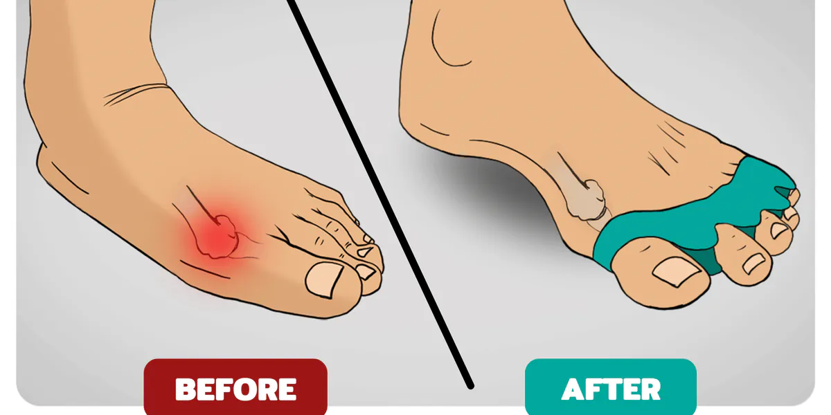 The Complete Guide to Fixing Bunions (10 Science-Based Steps)