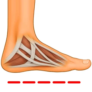 Fallen arches and flat feet