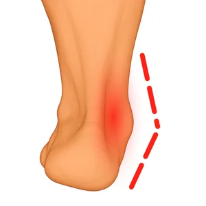 Overpronation of the foot